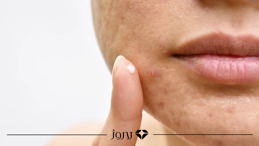 آیا ضدآفتاب واقعاً باعث جوش می‌شود